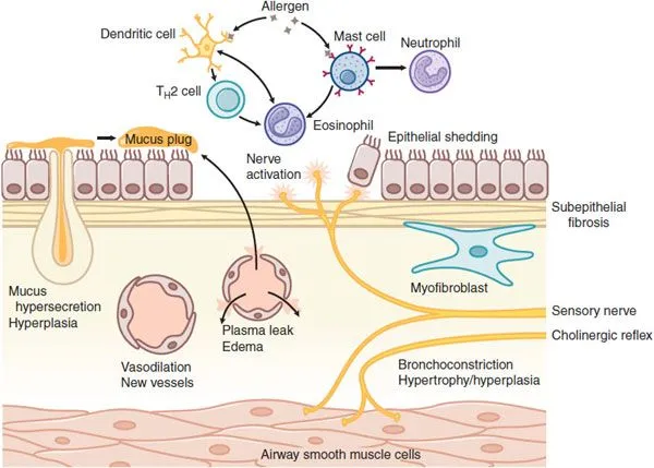 Mechanisms of airway obstruction in asthma