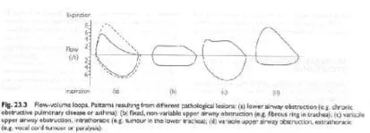 Flow-volume loops in various airway obstructions