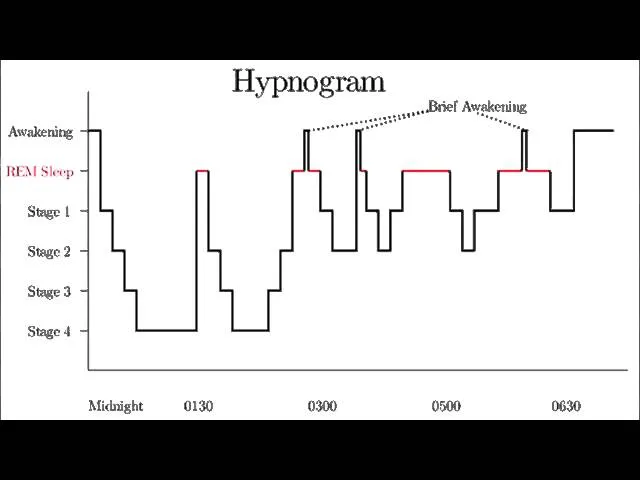 Hypnogram of sleep stages and awakenings