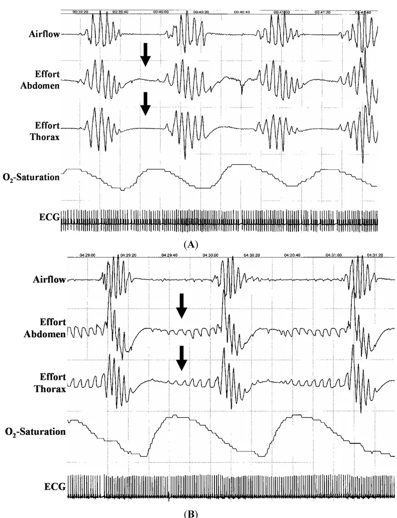 Obstructive Sleep Apnea Polysomnography