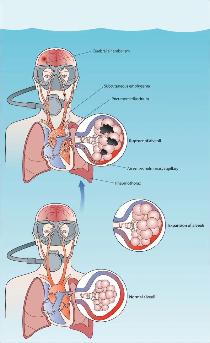Pulmonary barotrauma in diving