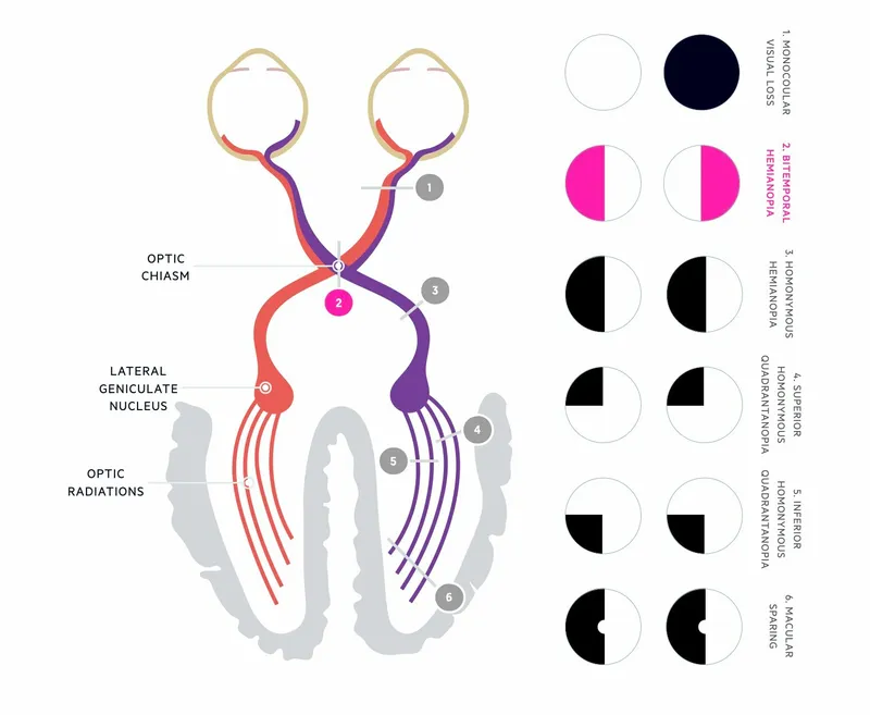 Visual pathway lesions and visual field defects