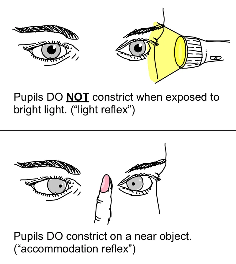 Argyll Robertson Pupil vs Normal Pupillary Light Reflex