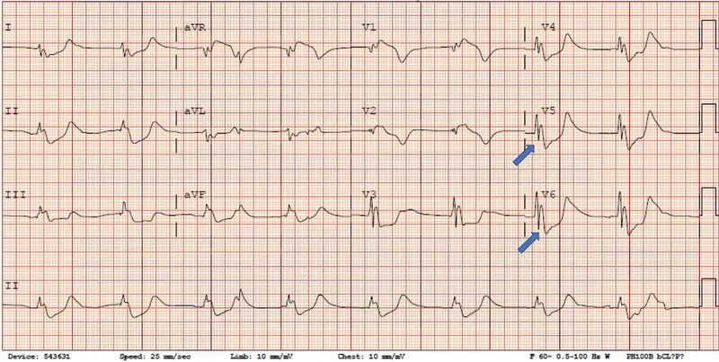 ECG showing Osborn J waves in hypothermia