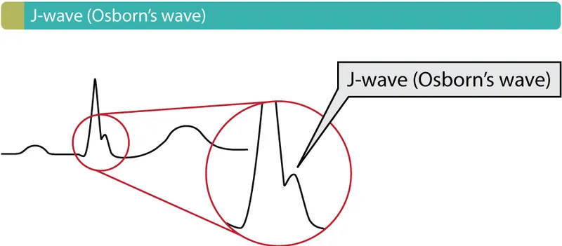ECG showing J-wave (Osborn's wave) in hypothermia