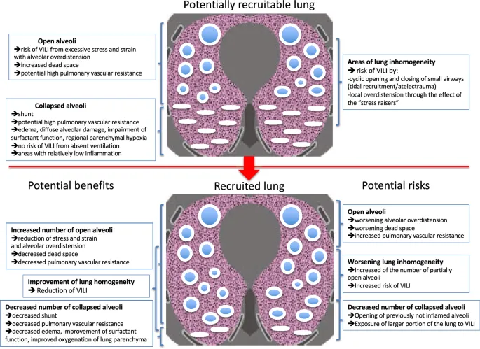 Lung recruitment: benefits and risks