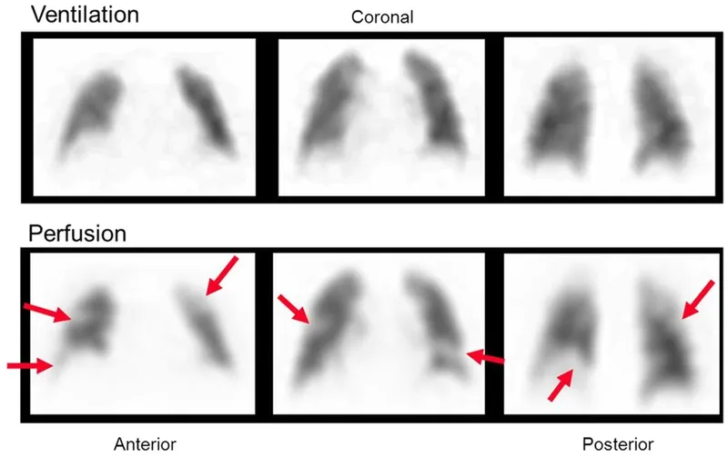 V/Q scan showing perfusion defects in pulmonary embolism