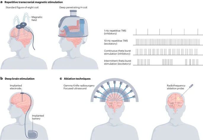 Neuromodulation & Ablation for Anxiety