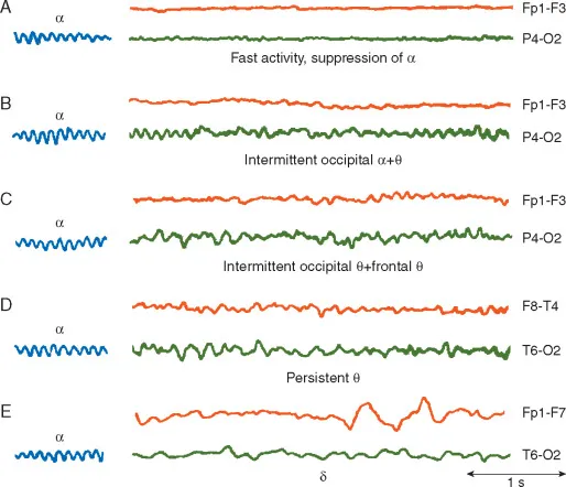 EEG patterns in delirium, showing diffuse slowing