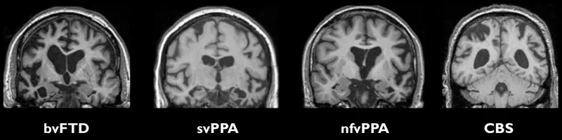 MRI scans of brain atrophy in FTD variants