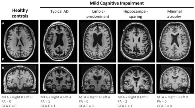 MRI of brain atrophy patterns in Mild Cognitive Impairment