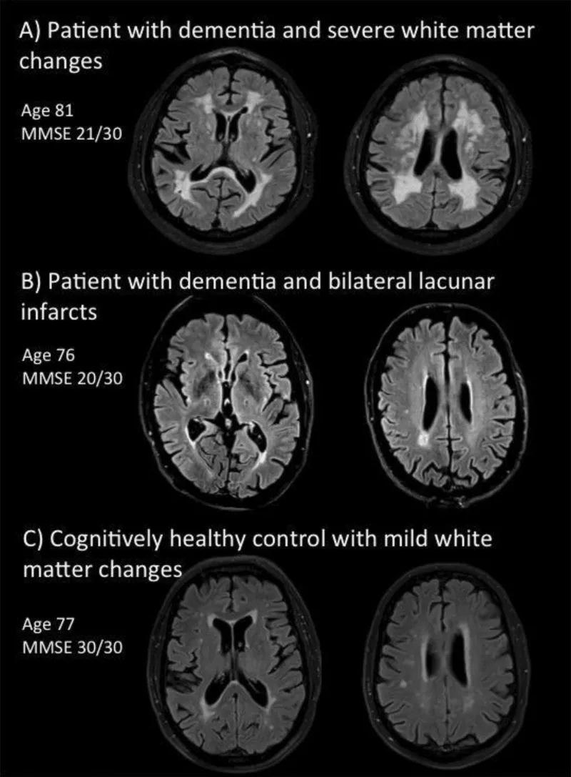 MRI scans: Vascular dementia vs. healthy control