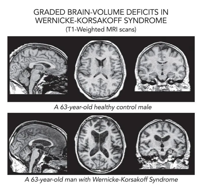 Brain volume deficits in Wernicke-Korsakoff Syndrome