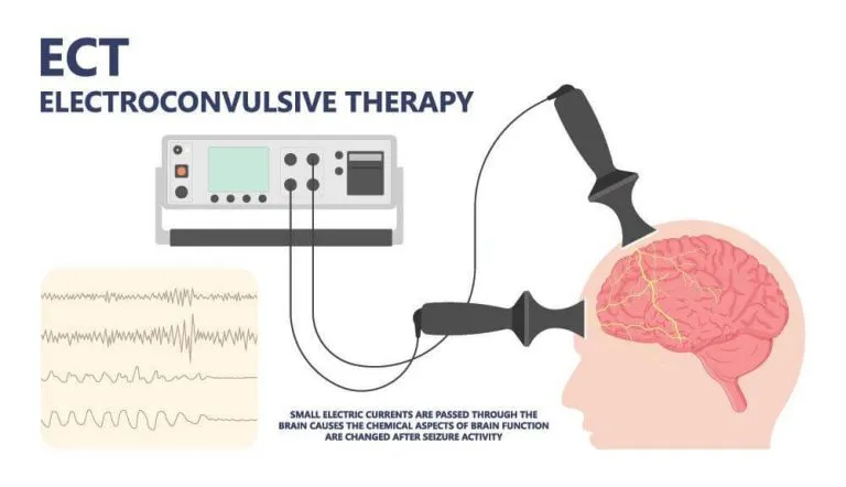 Electroconvulsive Therapy (ECT) Diagram