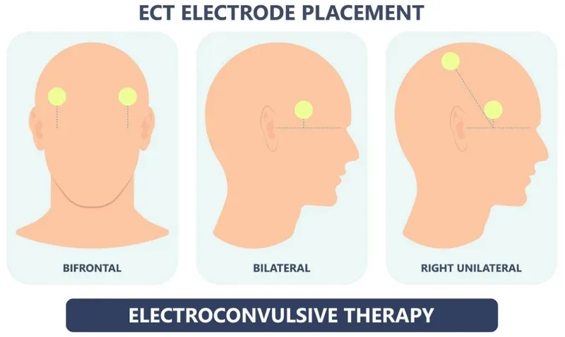 ECT Electrode Placement: Bifrontal, Bilateral, Unilateral