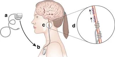 Vagus Nerve Stimulation (VNS) Device Placement
