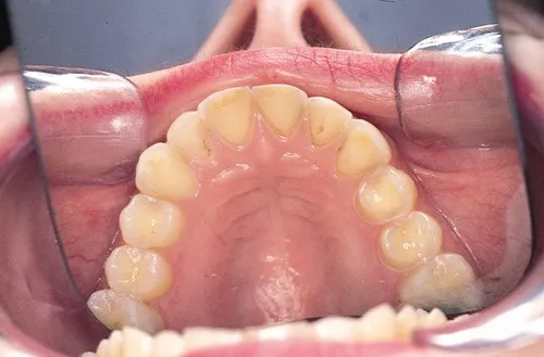 Dental erosion from bulimia nervosa