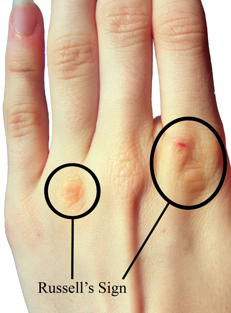 Russell's sign on knuckles