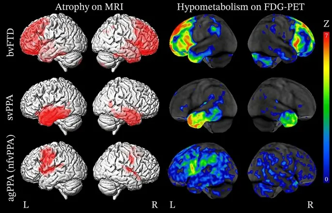 FTD subtypes: Atrophy on MRI and hypometabolism on FDG-PET