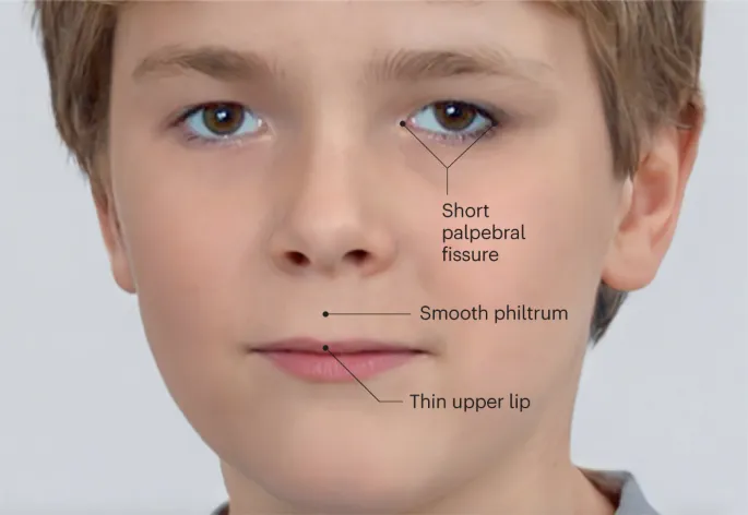 Facial features of Fetal Alcohol Syndrome (FAS)