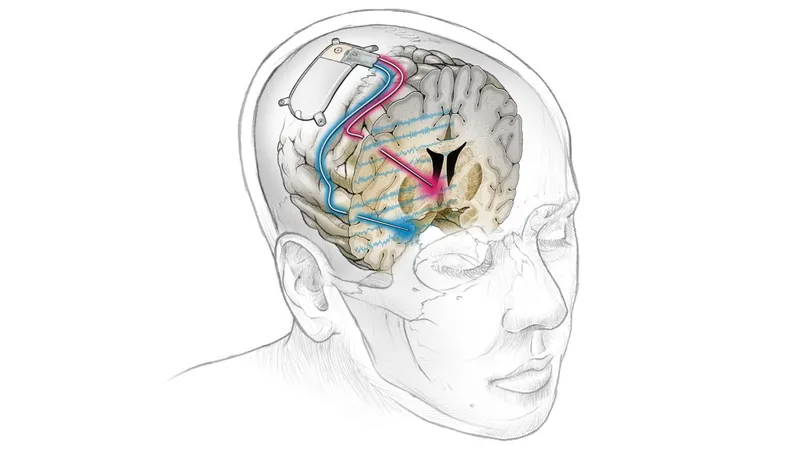Deep Brain Stimulation (DBS) Diagram