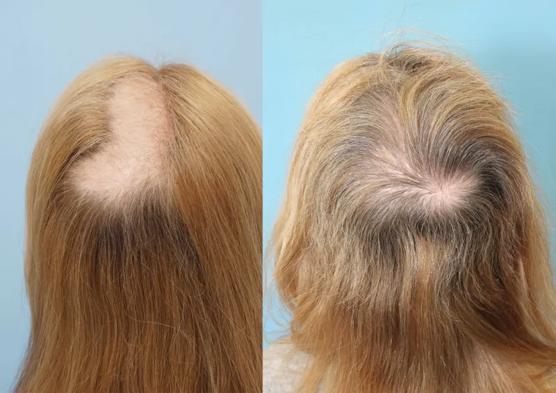Trichotillomania hair loss patches