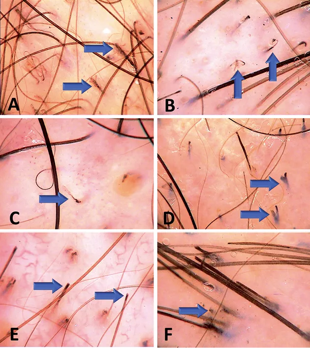 Trichotillomania scalp hair findings