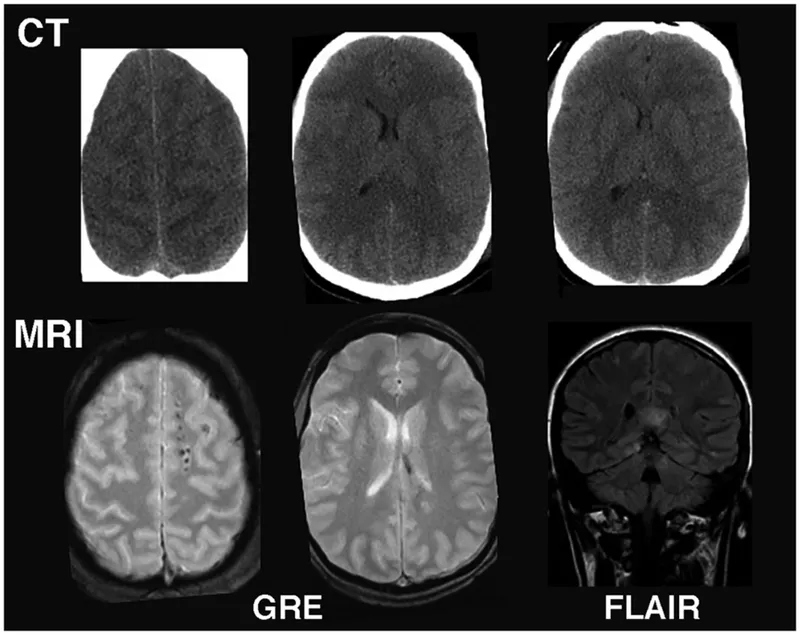 CT vs MRI Brain Scans