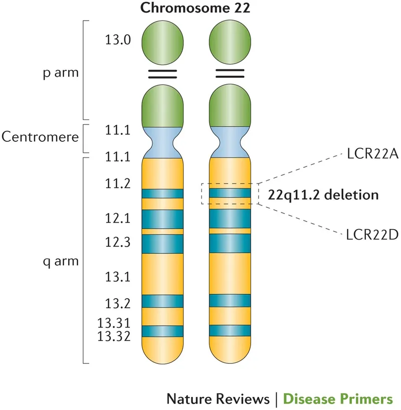 Chromosome 22 with 22q11.2 deletion