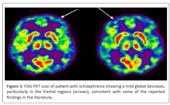 PET scan of schizophrenic brain showing hypofrontal activity