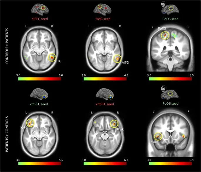 fMRI: Brain Connectivity Differences in Schizophrenia