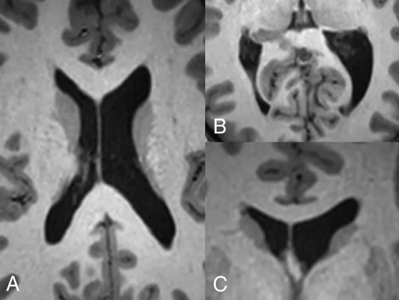 Coronal MRI: Enlarged lateral ventricles in schizophrenia