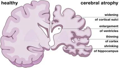 Cerebral Atrophy vs. Healthy Brain