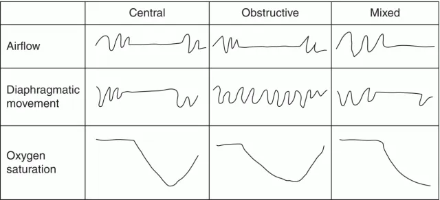 Polysomnography: Obstructive vs Central Apnea Tracing