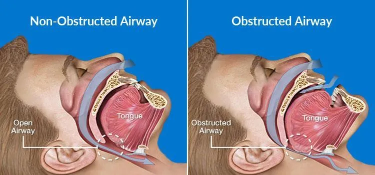 Non-obstructed vs. obstructed airway in sleep apnea