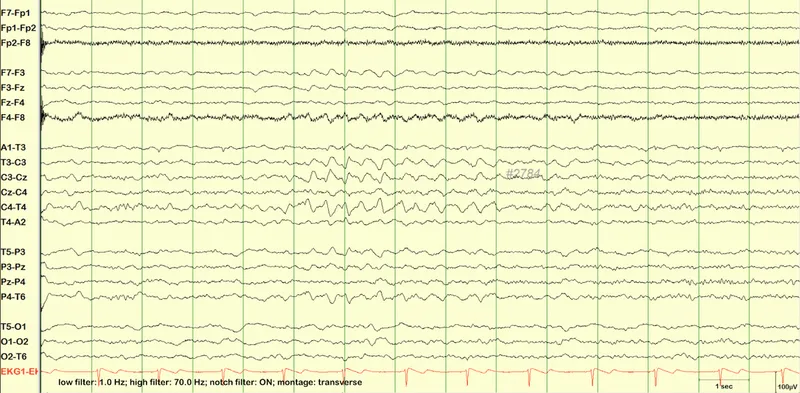 EEG of REM sleep with sawtooth waves