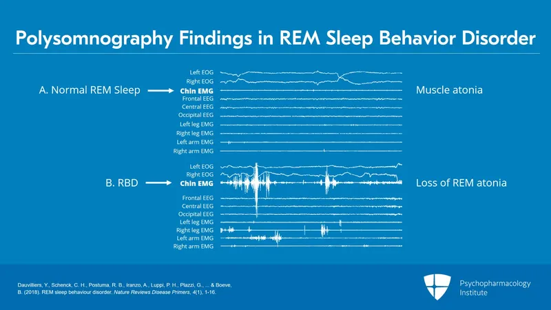 Polysomnography: Normal REM sleep vs. RBD