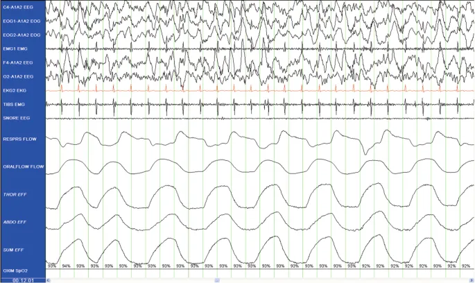 Polysomnography montage showing EEG, EOG, EMG, and flow