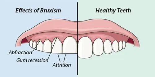 Effects of Bruxism vs. Healthy Teeth