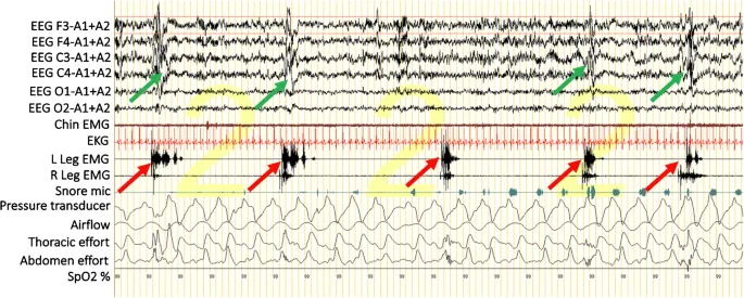 Polysomnography of periodic limb movements in sleep