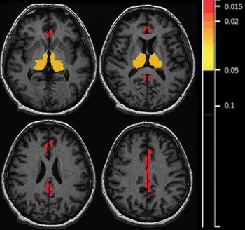 Brain MRI: Thalamic Atrophy in Fatal Familial Insomnia