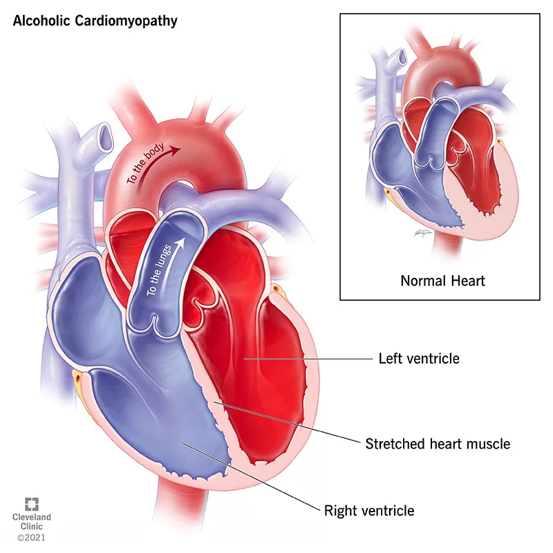 Alcoholic Cardiomyopathy vs. Normal Heart