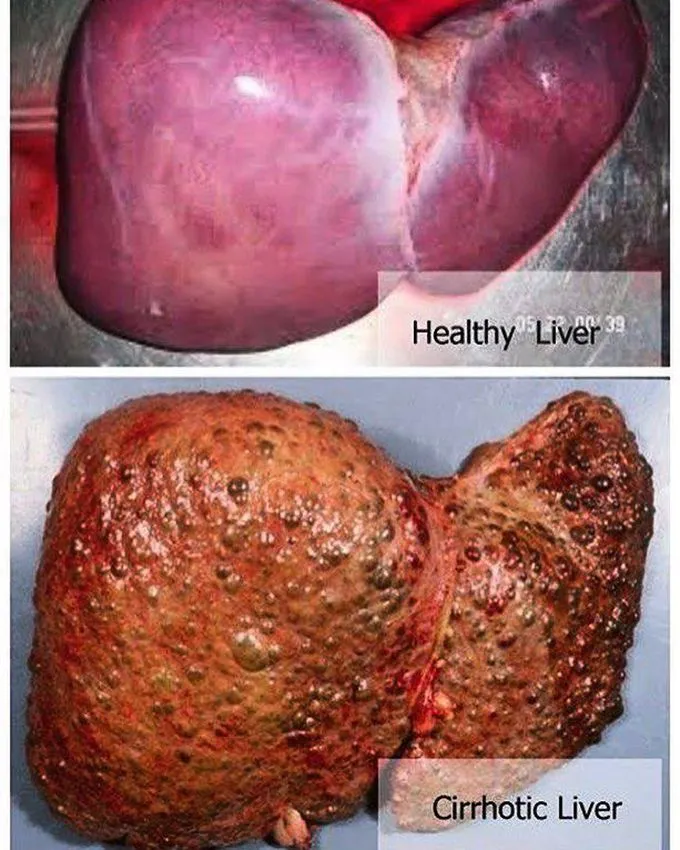 Healthy vs. Cirrhotic Liver Gross Specimen