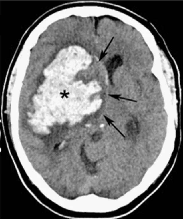 CT scan: Intracerebral hemorrhage from stimulant use