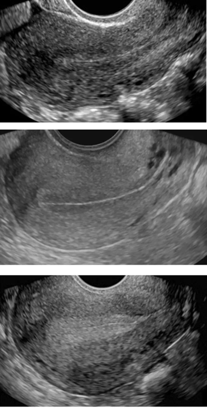 Sagittal ultrasound of uterus showing endometrial stripe