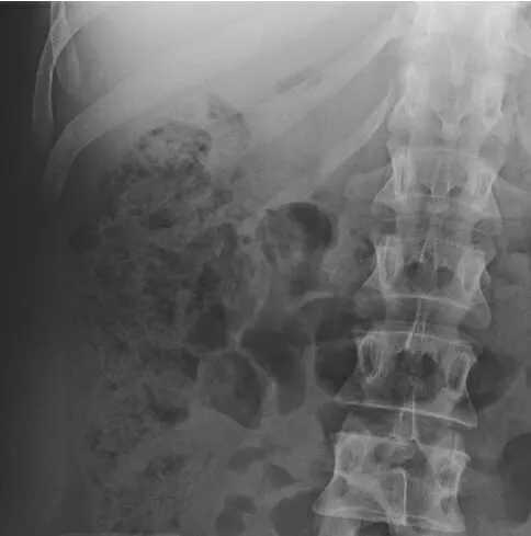 Abdominal X-ray showing fecal loading