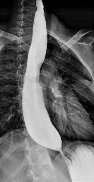 Barium swallow showing bird beak sign in achalasia