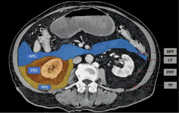 Axial CT: Retroperitoneal spaces