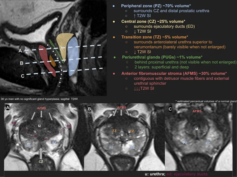 Prostate MRI T2W zonal anatomy