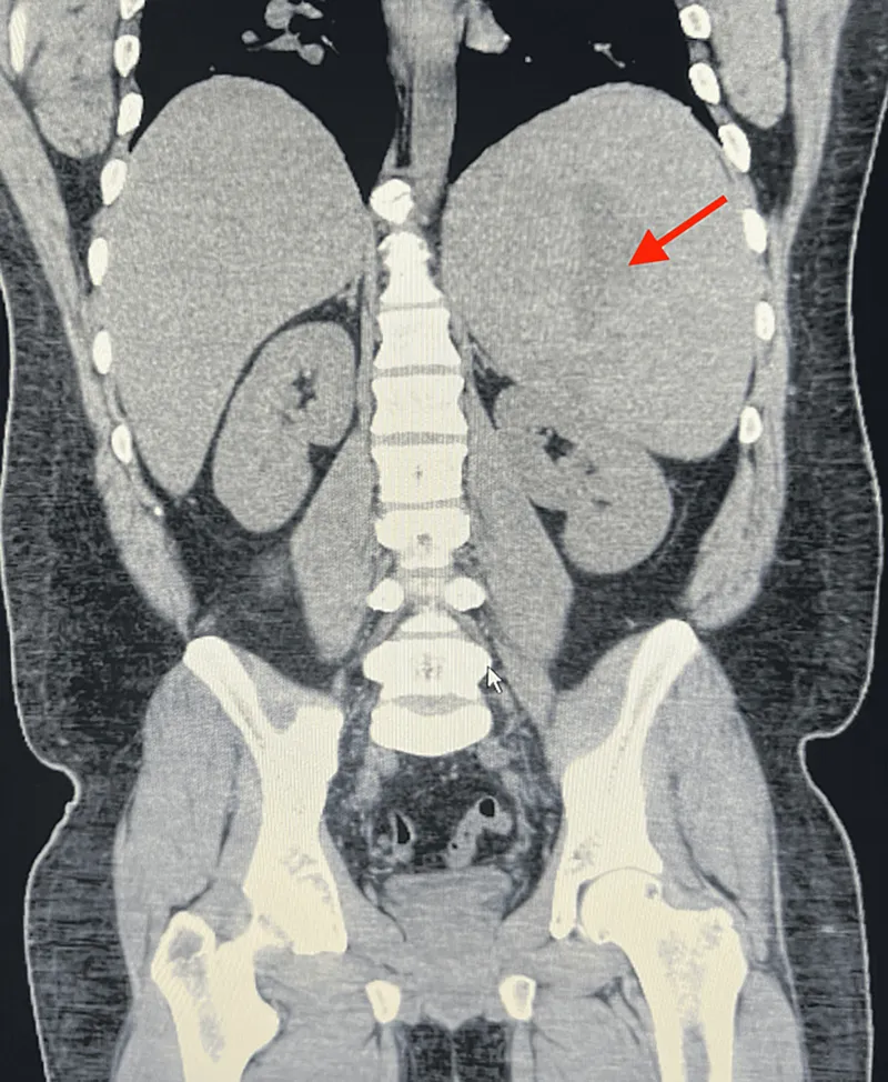 CT scan showing marked splenomegaly